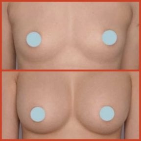 Before and after breast augmentation results at DGB Clinic – enhanced breast volume