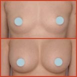 Before and after breast augmentation results at DGB Clinic – enhanced breast volume