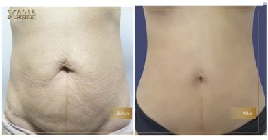 Before and after tummy tuck results at ASIA CLINIC – visible abdominal contour improvement