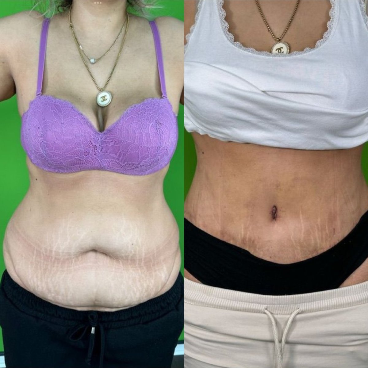 Результаты липосакции до и после в клинике эстетической хирургии проф. Карабекмеза