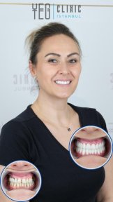 Vorher-nachher-Ergebnisse Zahnersatz bei YEG Clinic, verbesserte Lächeln-Transformation