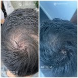 Before and after stem cell hair transplant results at Immunotherapy Regenerative Medicine clinic
