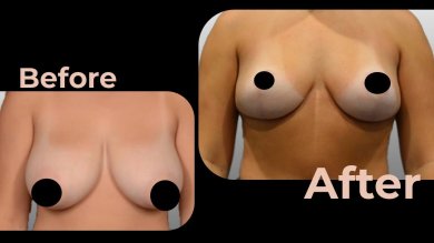 Vorher-nachher-Ergebnis Brustimplantate mit Straffung in Avicenna International Hospital, verbesserte Form