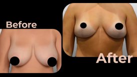 Vorher-nachher-Ergebnis Brustimplantate mit Straffung in Avicenna International Hospital, verbesserte Form