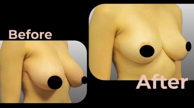 Vorher-nachher-Ergebnis Brustimplantate mit Straffung in Avicenna International Hospital