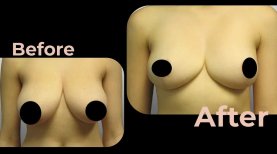 Vorher-nachher-Ergebnis Brustimplantate mit Straffung in Avicenna International Hospital