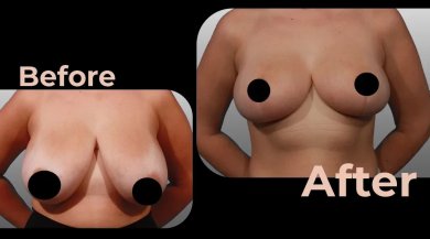 Vorher-nachher-Ergebnis Brustimplantate mit Straffung in Avicenna International Hospital