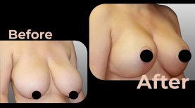 Vorher-nachher-Ergebnis Brustimplantate mit Straffung bei Avicenna International Hospital