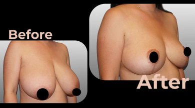 Vorher-nachher-Ergebnis Brustimplantate mit Straffung bei Avicenna International Hospital, verbesserte Form