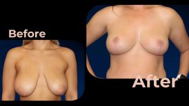 Vorher-nachher-Ergebnisse Brustimplantate mit Straffung bei Avicenna International Hospital