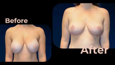 Vorher-nachher-Ergebnis Brustimplantate mit Straffung in Avicenna International Hospital