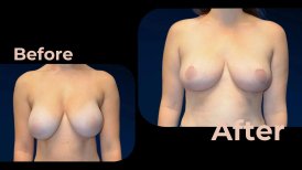 Vorher-nachher-Ergebnis Brustimplantate mit Straffung in Avicenna International Hospital