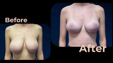 Vorher-nachher Brustimplantate mit Straffung bei Avicenna International Hospital, verbessertes Ergebnis