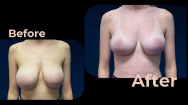 Vorher-nachher Brustimplantate mit Straffung bei Avicenna International Hospital, verbessertes Ergebnis
