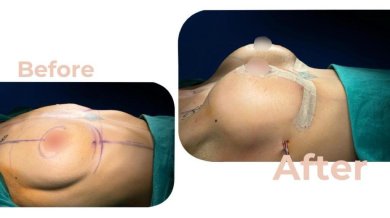 Vorher-nachher-Ergebnis Brustimplantate mit Straffung in Avicenna International Hospital