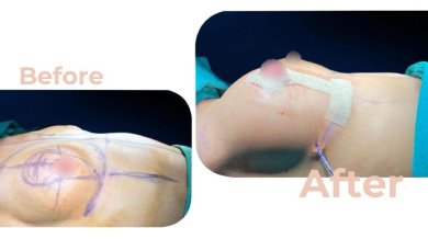 Vorher-nachher-Ergebnis Brustimplantate mit Straffung in Avicenna International Hospital