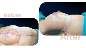 Vorher-nachher-Ergebnis Brustimplantate mit Straffung in Avicenna International Hospital