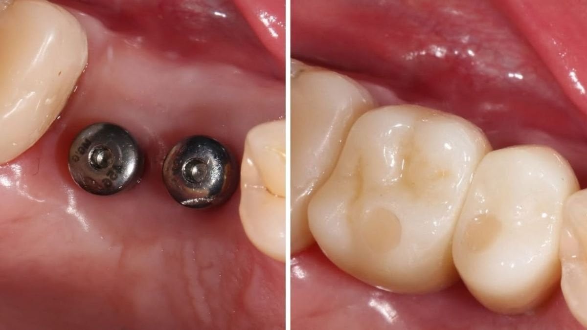 نتائج قبل وبعد زراعة الأسنان مع التاج في Smile Centrum – استعادة وظيفة المضغ