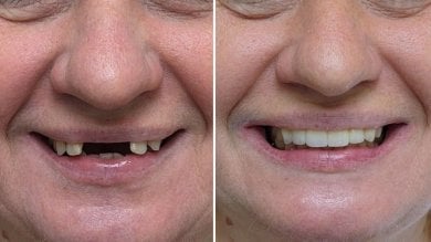 Vorher-nachher-Ergebnis Zahnimplantat mit Krone bei Smile Centrum – Lächeln wiederhergestellt