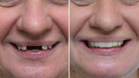 Vorher-nachher-Ergebnis Zahnimplantat mit Krone bei Smile Centrum – Lächeln wiederhergestellt