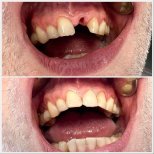 Vorher-nachher Zahnimplantat mit Krone bei Smile Centrum – Frontzahn wiederhergestellt