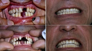 Before and after dental implant with crown results at Smile Centrum, restored full smile