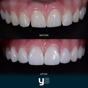 Before and after gum surgery results at YeahSmile – improved gum line and smile aesthetics