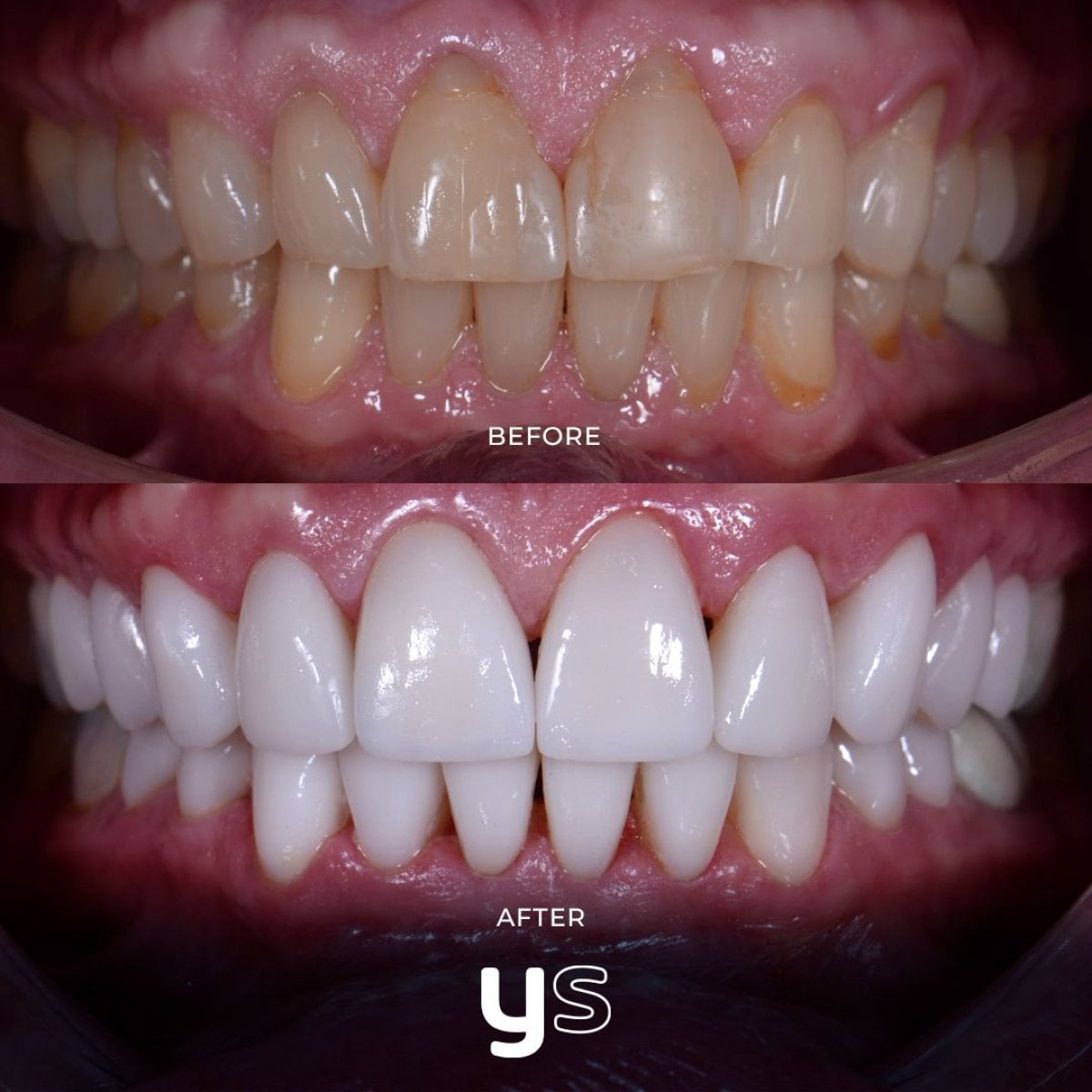 نتائج قبل وبعد جراحة اللثة في YeahSmile – خط لثة محسن وابتسامة أكثر إشراقًا
