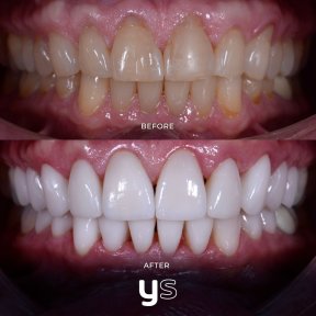 Before and after gum surgery results at YeahSmile – improved gum line and brighter smile