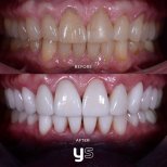 Before and after gum surgery results at YeahSmile – improved gum line and brighter smile