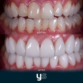 Before and after gum surgery results at YeahSmile – improved gum line and whiter teeth