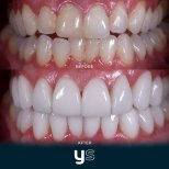 Before and after gum surgery results at YeahSmile – improved gum line and whiter teeth