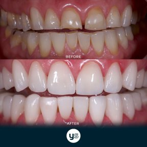 Before and after gum surgery results at YeahSmile – improved gum health and smile aesthetics