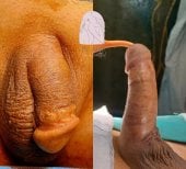 Before and after phalloplasty results at Dr. MED – visible penis reconstruction and enhancement