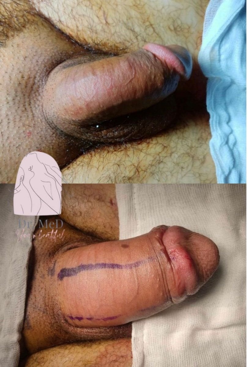 Resultados de faloplastia antes y después en Dr. MED – mejora y contorno del pene