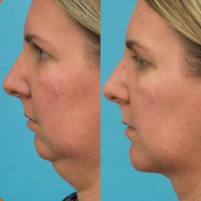 Vorher-nachher-Ergebnis Kinnimplantat bei Adem and Havva Medical Center, verbesserte Kontur