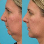 Vorher-nachher-Ergebnis Kinnimplantat bei Adem and Havva Medical Center, verbesserte Kontur