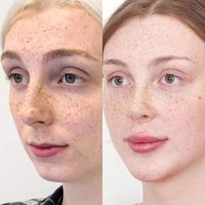 Vorher-nachher-Ergebnis Kinnimplantat bei Adem and Havva Medical Center, verbesserte Kontur