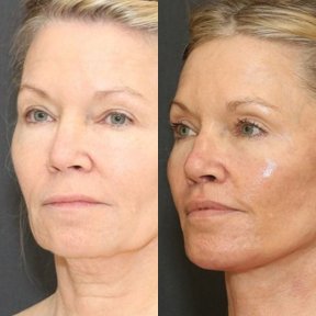 Vorher-nachher-Ergebnis Kinnimplantat bei Adem and Havva Medical Center, verbesserte Kontur