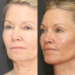 Vorher-nachher-Ergebnis Kinnimplantat bei Adem and Havva Medical Center, verbesserte Kontur