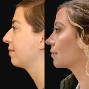 Vorher-nachher-Ergebnis Kinnimplantat bei Adem and Havva Medical Center, verbessertes Profil