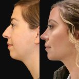 Vorher-nachher-Ergebnis Kinnimplantat bei Adem and Havva Medical Center, verbessertes Profil