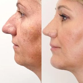 Vorher-nachher-Ergebnis Kinnimplantat bei Adem and Havva Medical Center, verbessertes Profil