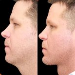 Vorher-nachher-Ergebnis Kinnimplantat bei Adem and Havva Medical Center, verbessertes Profil