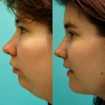 Vorher-nachher-Ergebnis Kinnimplantat bei Adem and Havva Medical Center, verbessertes Profil
