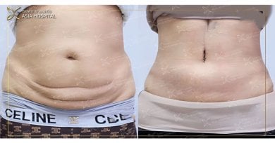 Before and after tummy tuck results at ASIA CLINIC – flatter abdomen and improved contour
