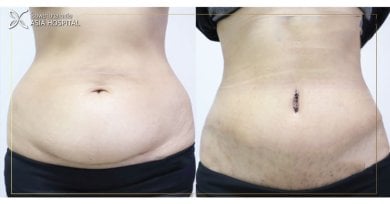 Before and after tummy tuck results at ASIA CLINIC, visible abdominal contour improvement