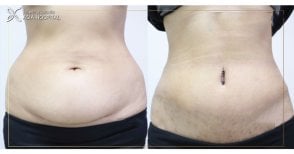 Before and after tummy tuck results at ASIA CLINIC, visible abdominal contour improvement