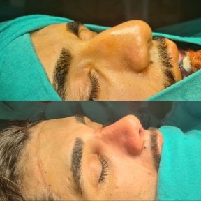 Efekty przed i po septoplastyce w ÜMRAN TIP MERKEZİ, poprawiony kształt nosa i oddychanie