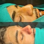 Efekty przed i po septoplastyce w ÜMRAN TIP MERKEZİ, poprawiony kształt nosa i oddychanie